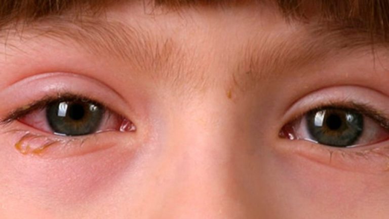 Conjuntivitis En Niños: Causas, Síntomas Y Tratamiento Adecuado